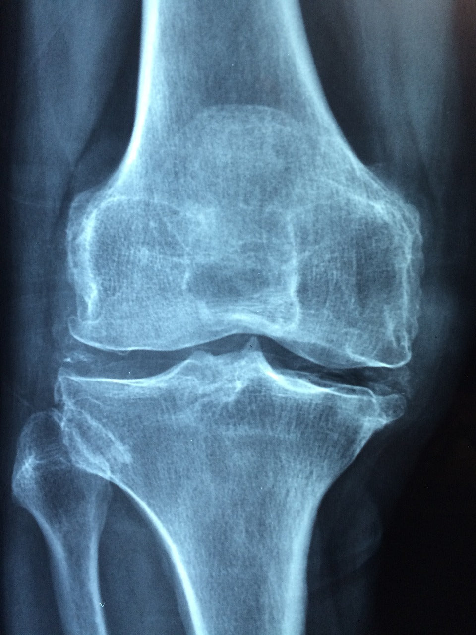 Excessive intake of sugar: An accomplice of inflammation
